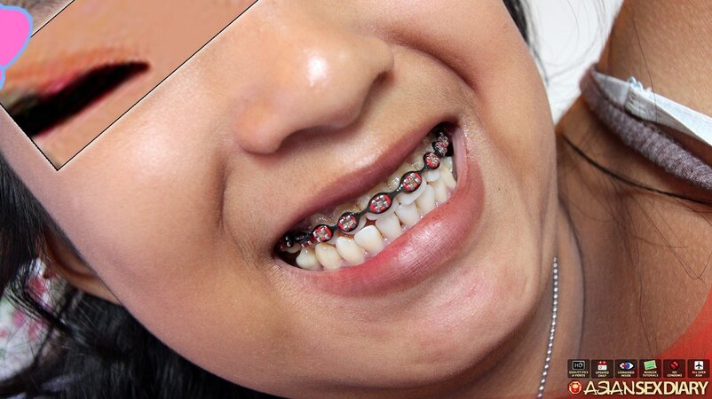 Thai girl with braces spreads legs under the condition that she remains anonymous